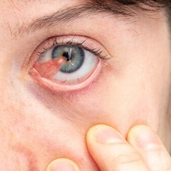 Pterygium Specialist in Orange County, CA